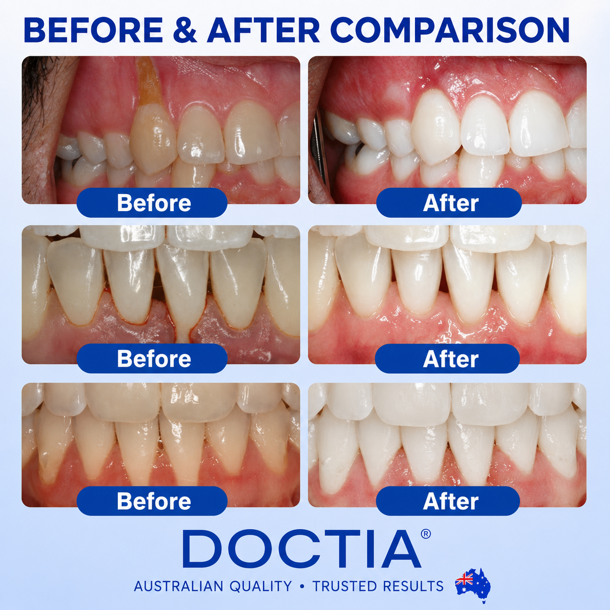 🇺🇸🏅🦷🛡️DOCTIA® GumRevive Periodontal Repair Gel