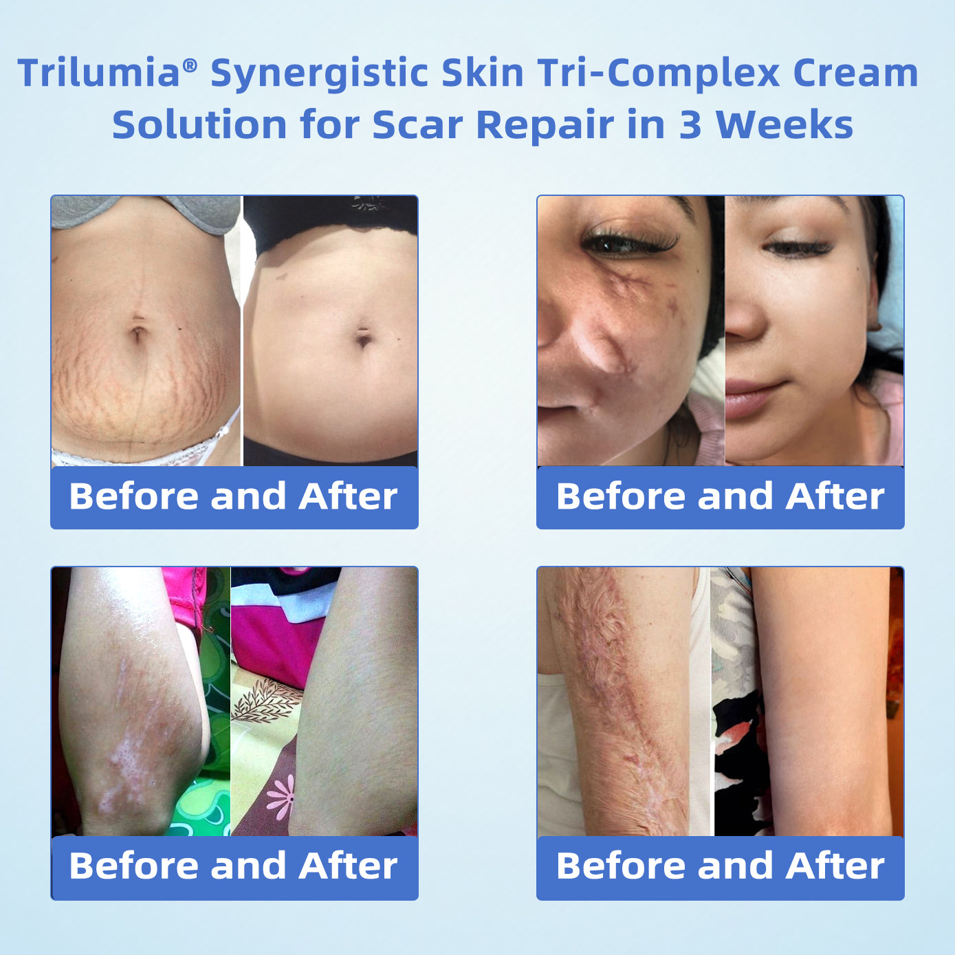 Trilumia® Synergistic Skin Tri-Complex Cream 💎(Copper Peptide+Growth Factors+Methylene Blue)🏆Next-Generation Biotech For Skin Repair